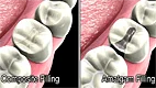 Dental Filling Materials