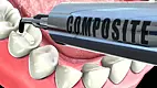 Composite Filling