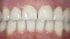 Home Teeth Whitening