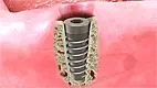 Implant for Crown & Bridge
