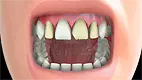 Veneer